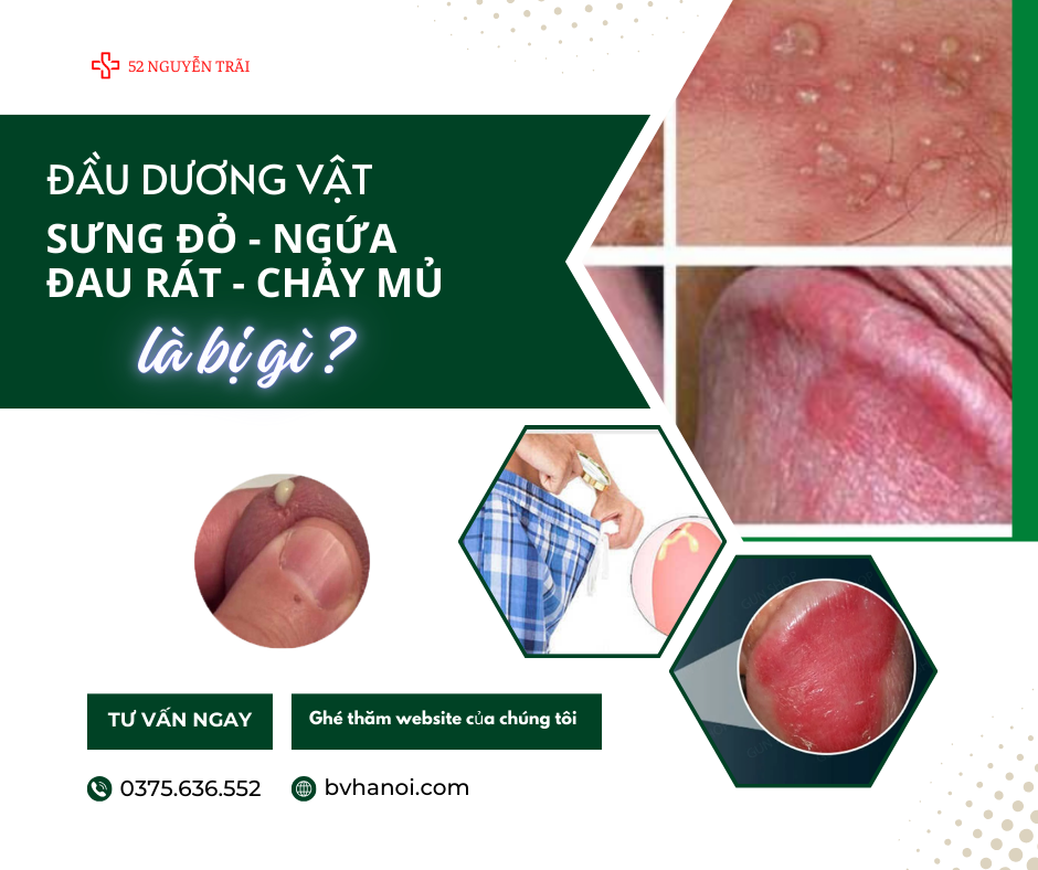 Dầu dương vật bị dưng đỏ, ngứa rát, chảy mủ