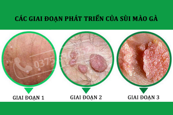 Các giai đoạn của sùi mào gà